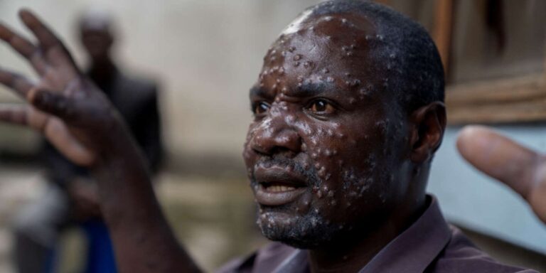 Une urgence lancée contre l’épidémie croissante de Mpox